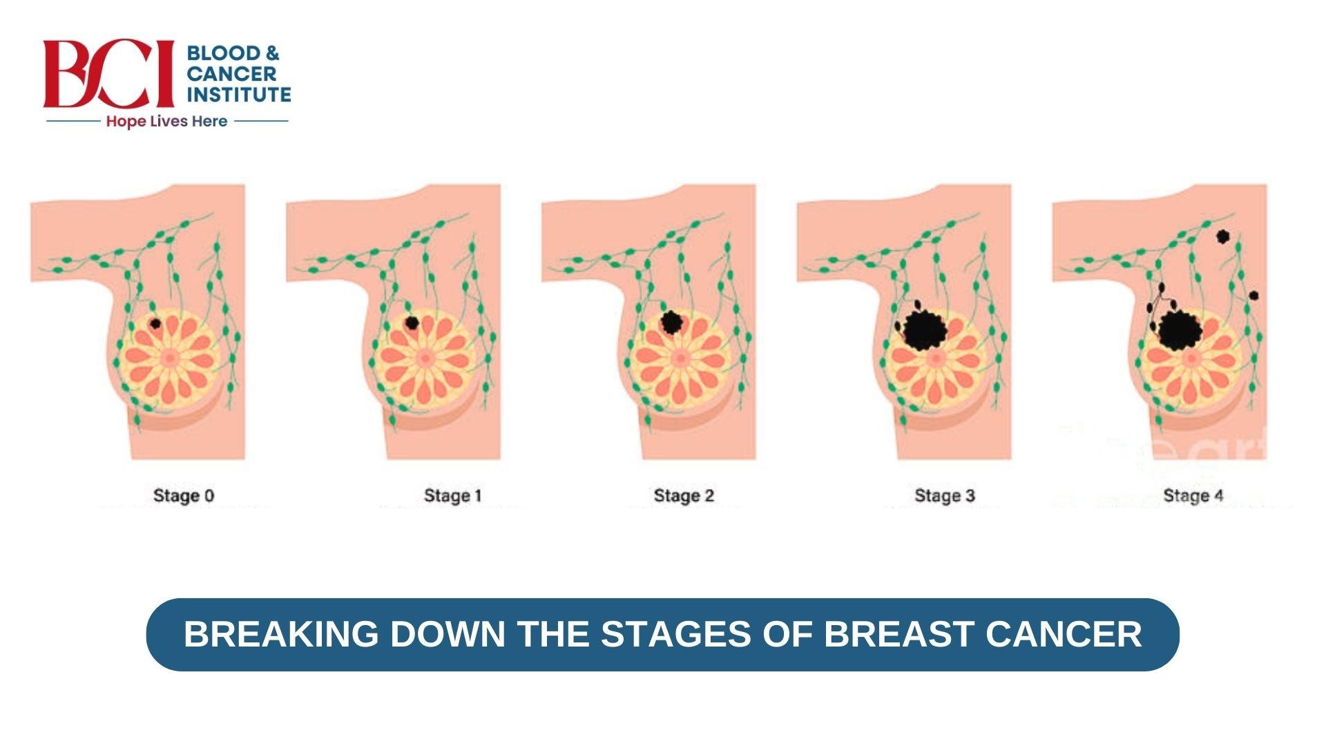 Breaking Down the Stages of Breast Cancer: A Comprehensive Guide