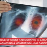 Role of Chest Radiographs in Early Diagnosing and Monitoring Lung Cancer