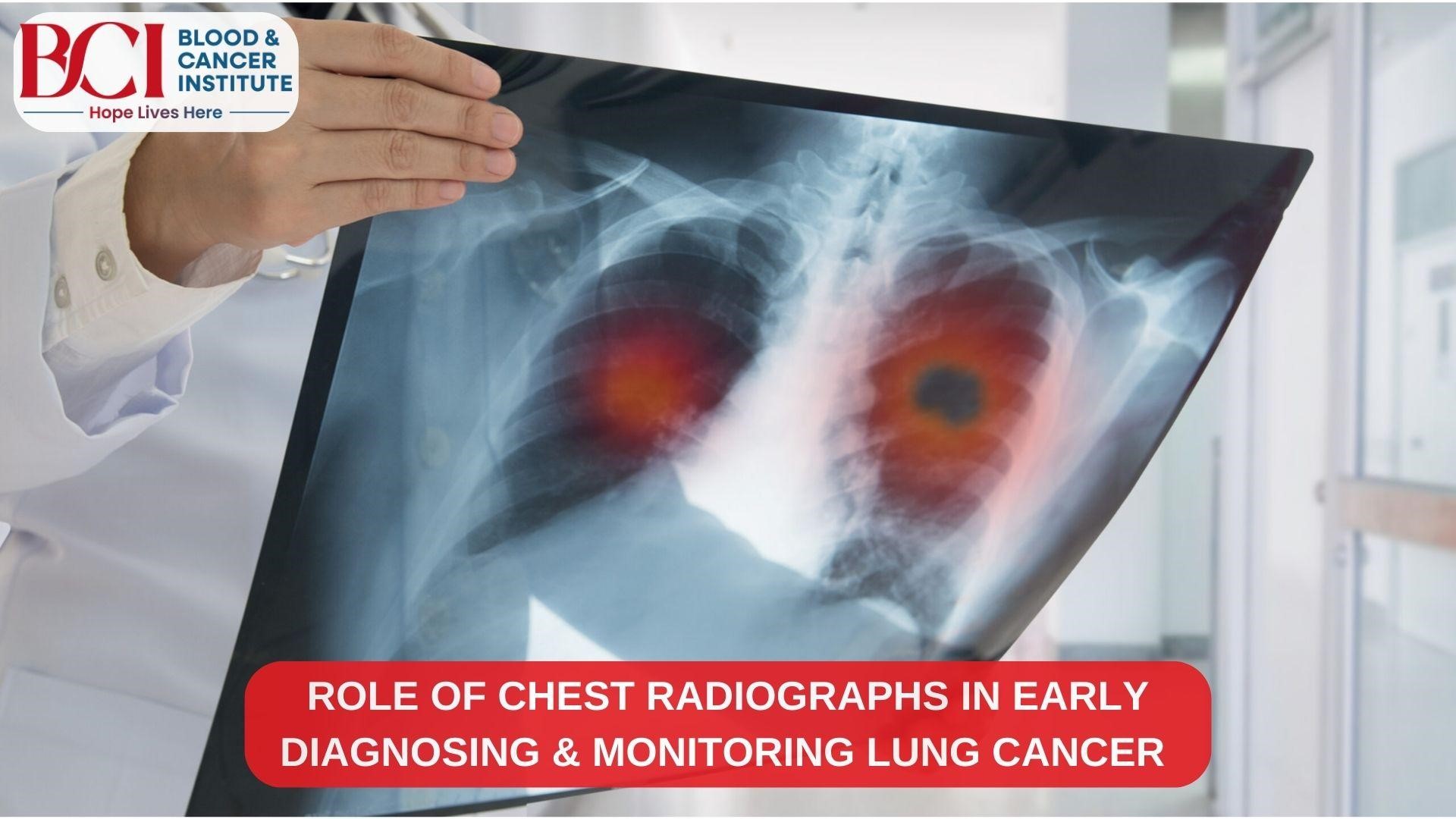 Role of Chest Radiographs in Early Diagnosing and Monitoring Lung Cancer