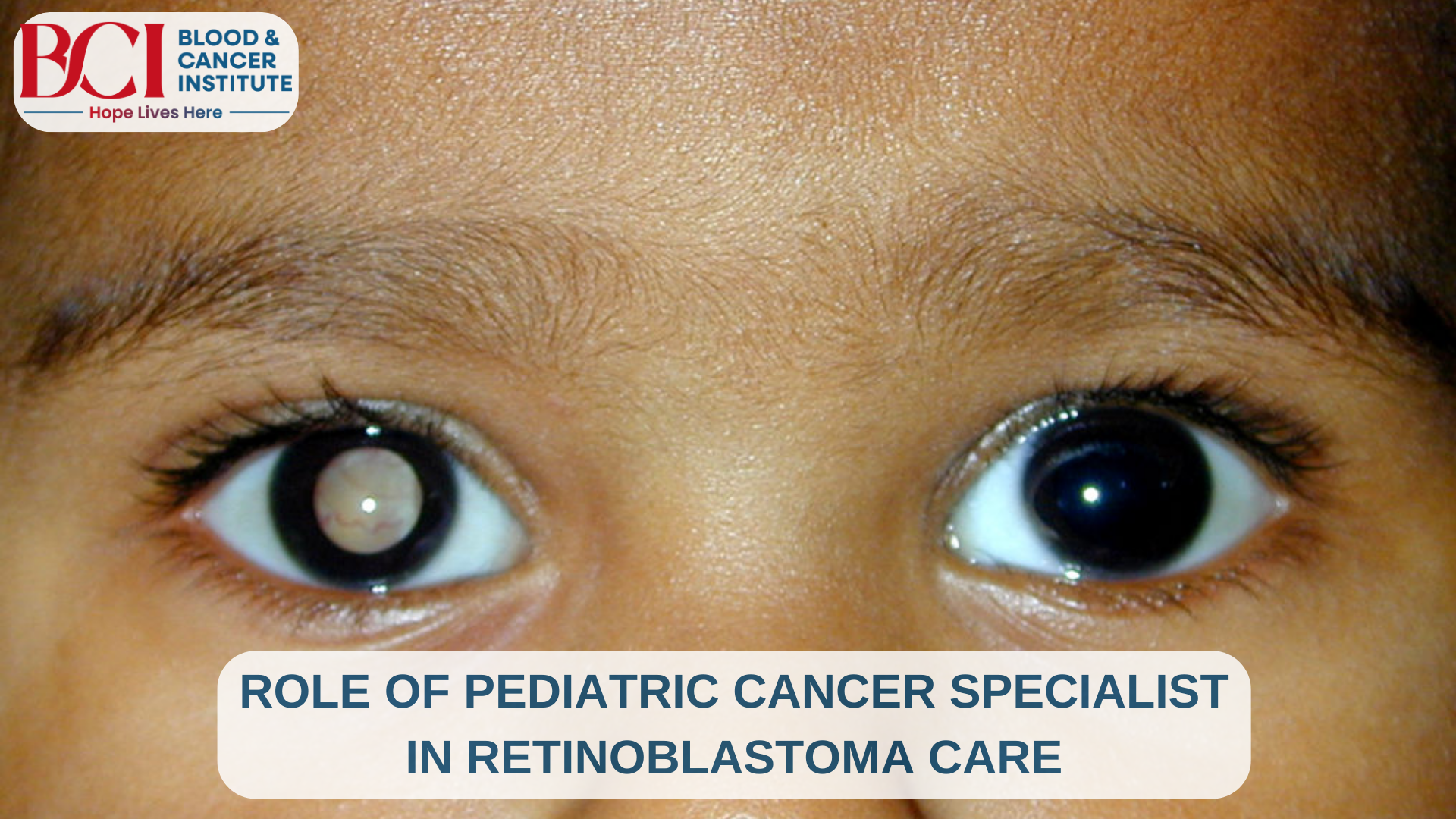 The Role of Pediatric Cancer Specialist in Retinoblastoma Care