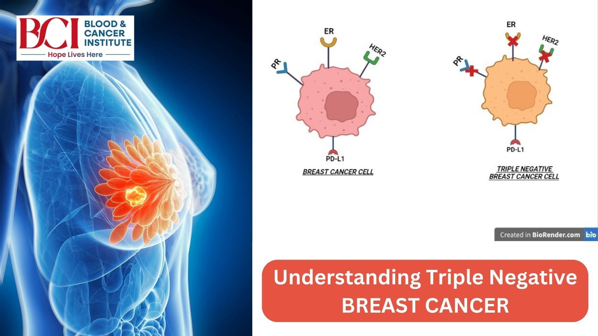 Understanding-Triple-Negative-Breast-Cancer.jpg