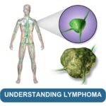 Understanding Lymphoma