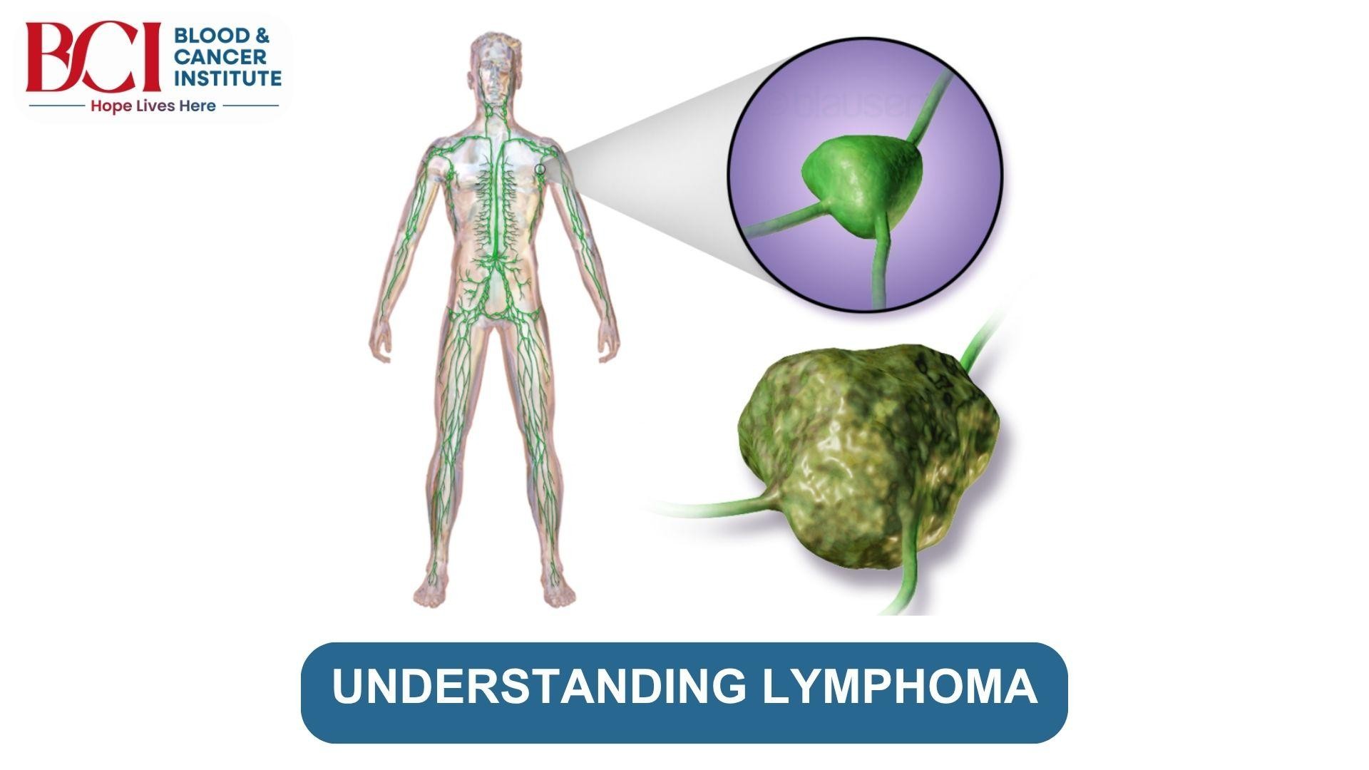 Understanding Lymphoma